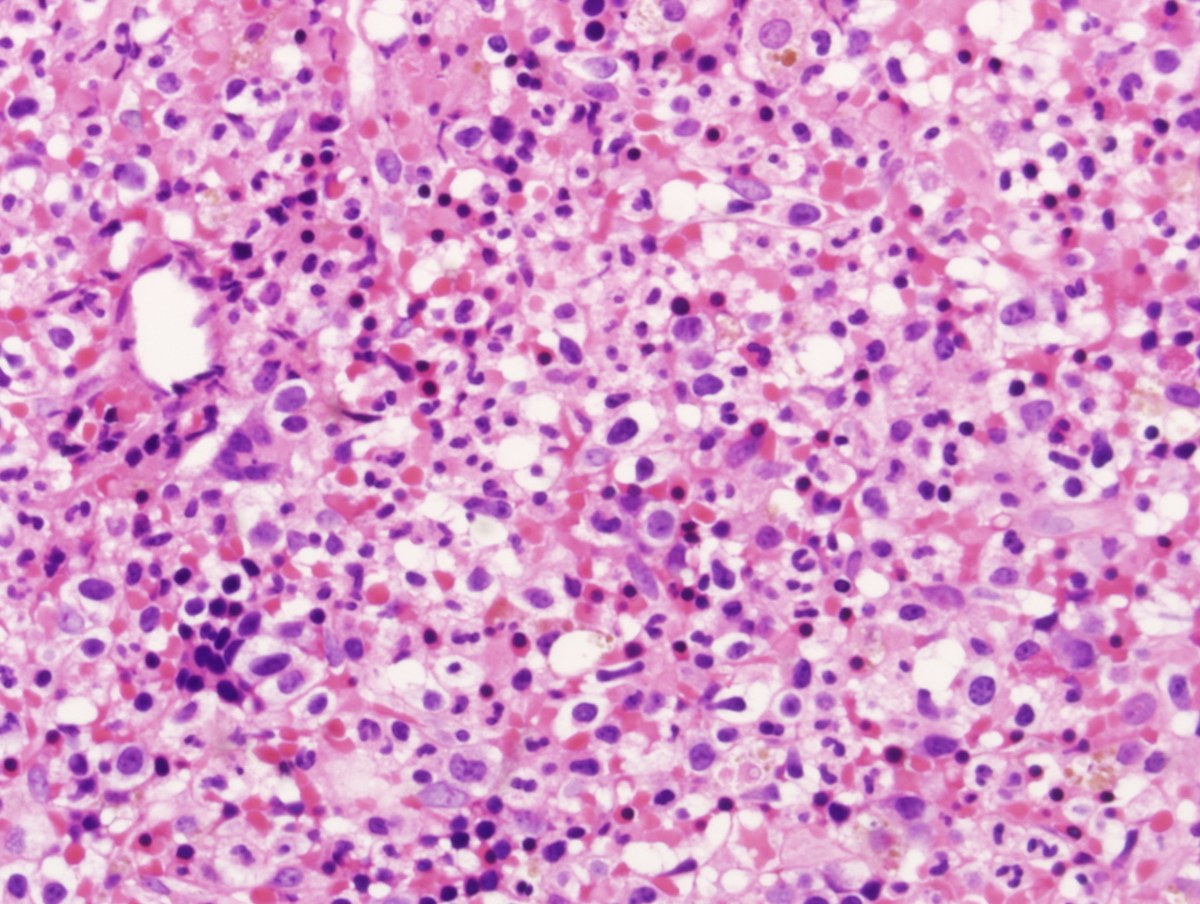 Bone marrow biopsy at second relapse (2/2012)